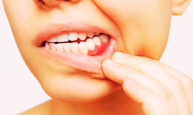 Oral Cancer