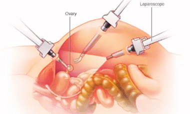 Ovary Removal