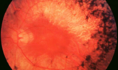 Retinitis Pigmentosa