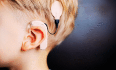cochlear implant