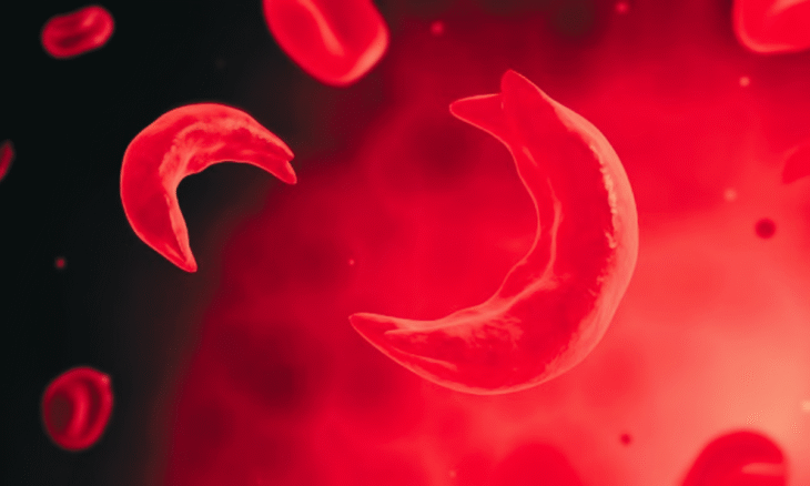 sickle cell